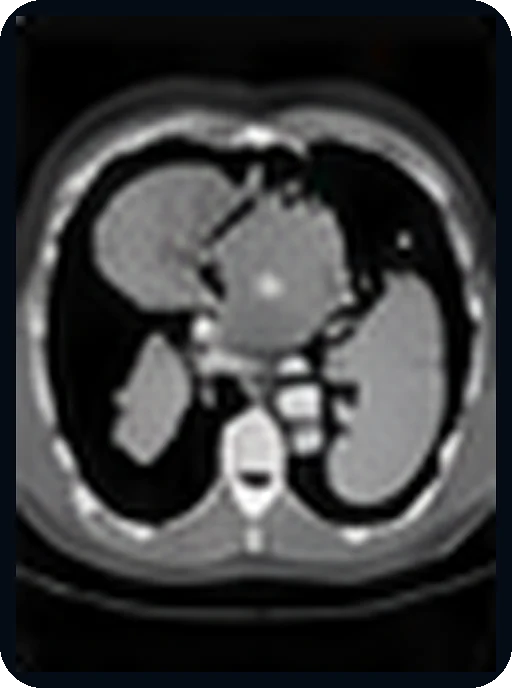 Examinare CT abdominală